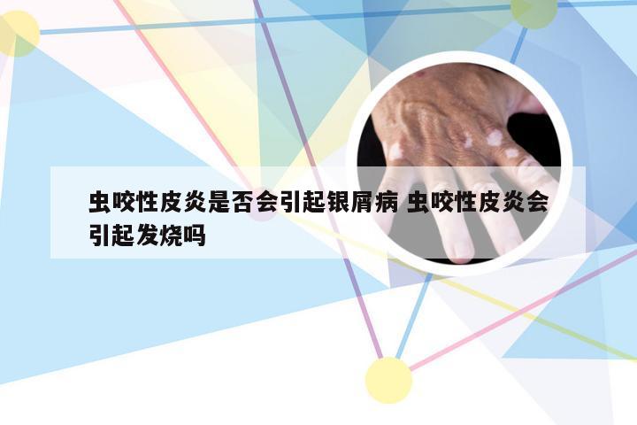 虫咬性皮炎是否会引起银屑病 虫咬性皮炎会引起发烧吗