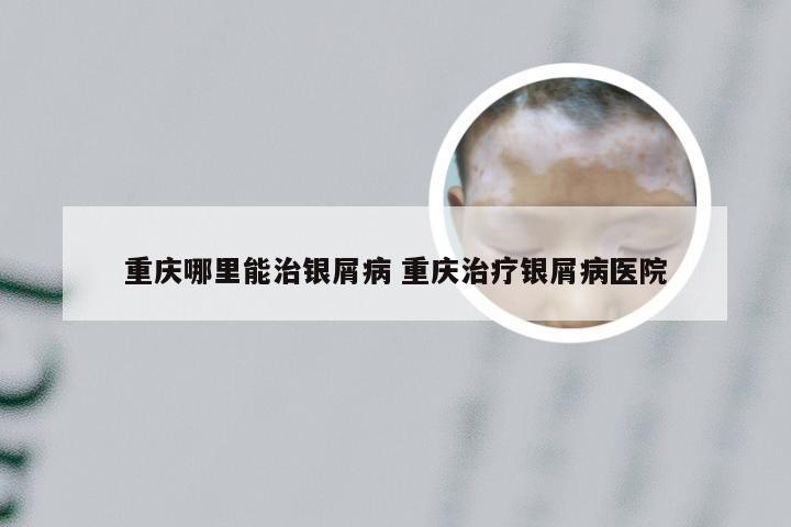 重庆哪里能治银屑病 重庆治疗银屑病医院
