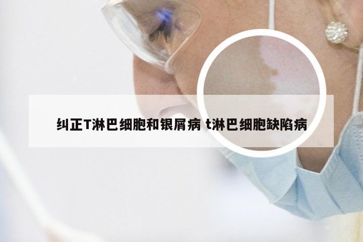纠正T淋巴细胞和银屑病 t淋巴细胞缺陷病