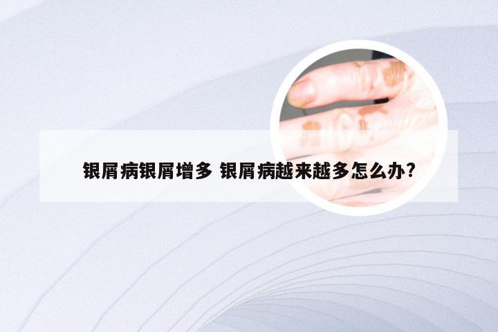 银屑病银屑增多 银屑病越来越多怎么办?