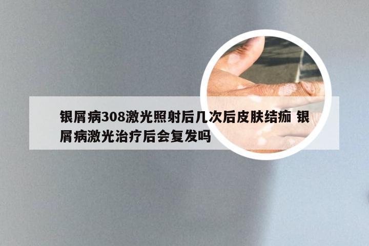 银屑病308激光照射后几次后皮肤结痂 银屑病激光治疗后会复发吗