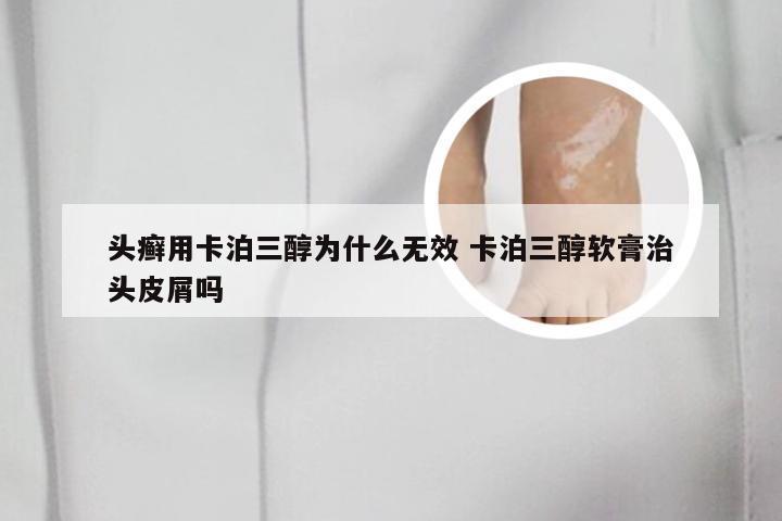 头癣用卡泊三醇为什么无效 卡泊三醇软膏治头皮屑吗
