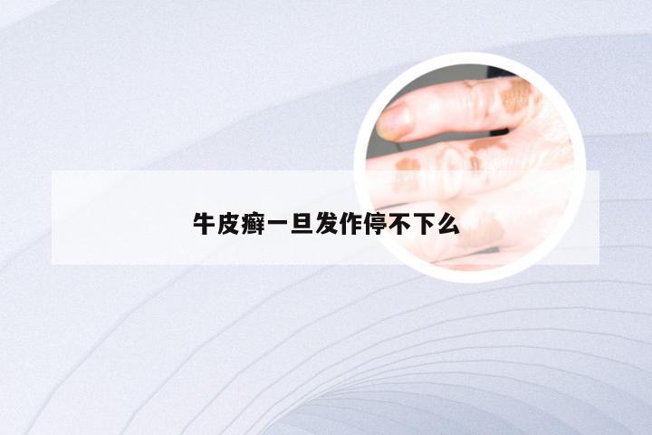 牛皮癣一旦发作停不下么