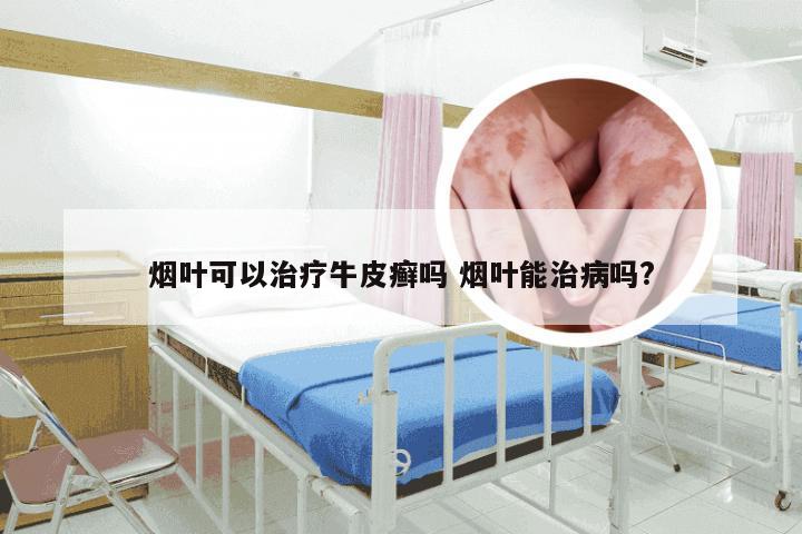 烟叶可以治疗牛皮癣吗 烟叶能治病吗?