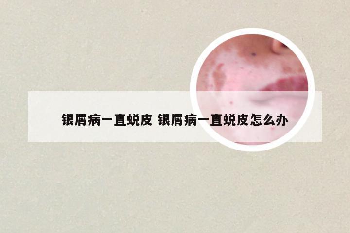 银屑病一直蜕皮 银屑病一直蜕皮怎么办