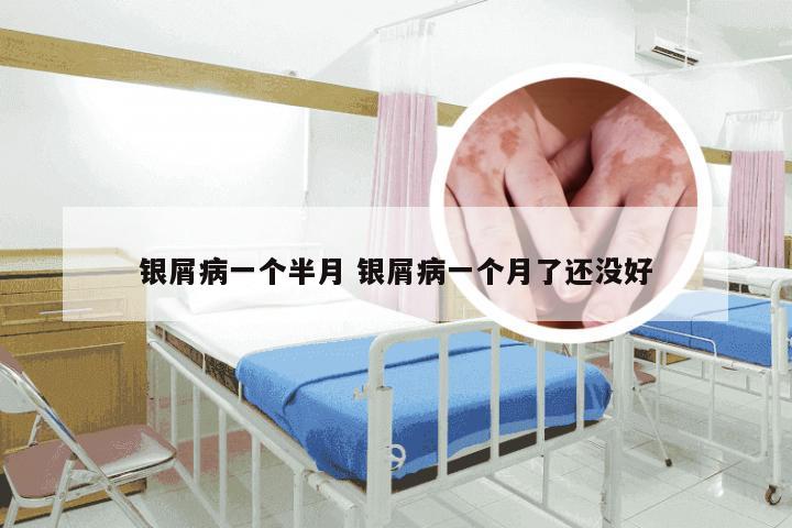 银屑病一个半月 银屑病一个月了还没好