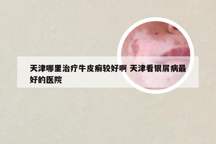 天津哪里治疗牛皮癣较好啊 天津看银屑病最好的医院