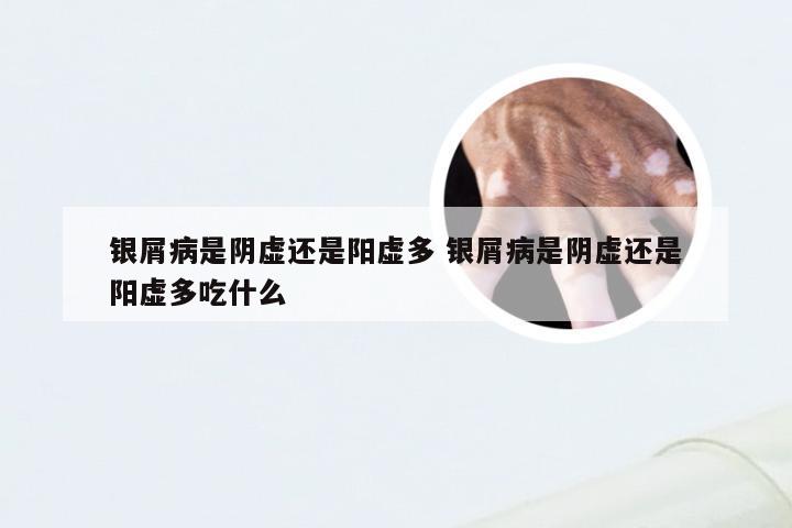 银屑病是阴虚还是阳虚多 银屑病是阴虚还是阳虚多吃什么