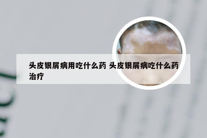 头皮银屑病用吃什么药 头皮银屑病吃什么药治疗