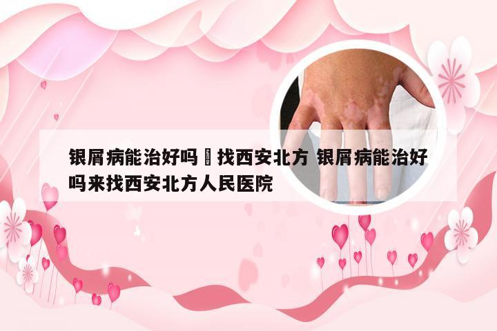 银屑病能治好吗來找西安北方 银屑病能治好吗来找西安北方人民医院