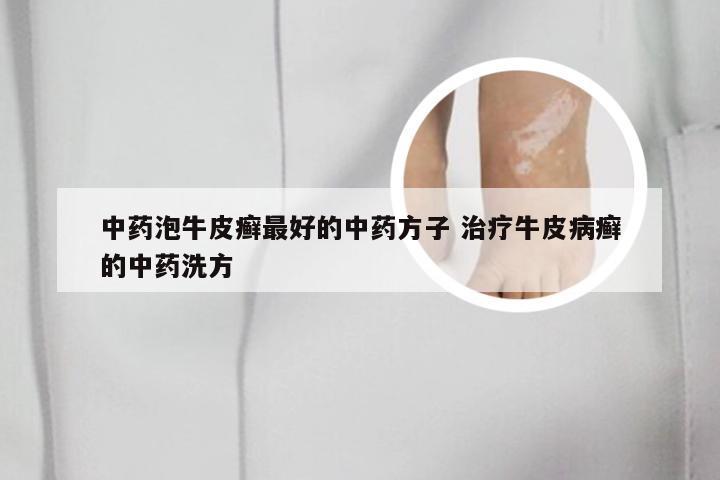 中药泡牛皮癣最好的中药方子 治疗牛皮病癣的中药洗方