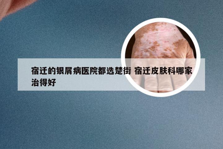 宿迁的银屑病医院都选楚街 宿迁皮肤科哪家治得好