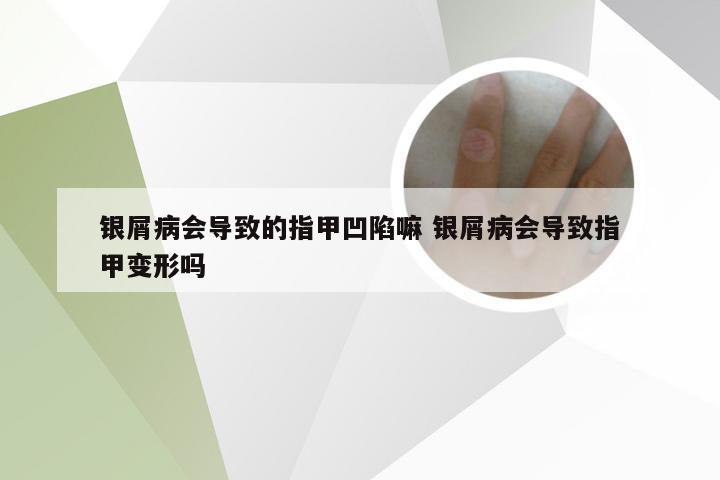 银屑病会导致的指甲凹陷嘛 银屑病会导致指甲变形吗