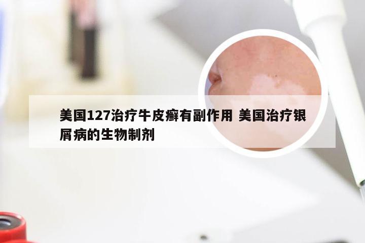 美国127治疗牛皮癣有副作用 美国治疗银屑病的生物制剂
