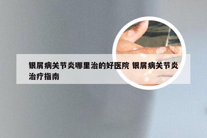 银屑病关节炎哪里治的好医院 银屑病关节炎治疗指南