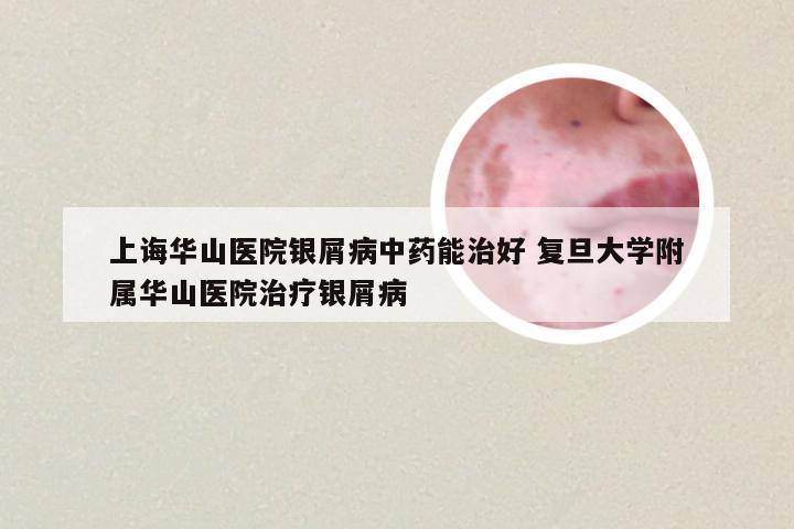 上诲华山医院银屑病中药能治好 复旦大学附属华山医院治疗银屑病