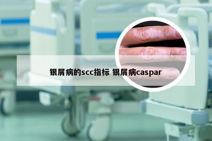 银屑病的scc指标 银屑病caspar