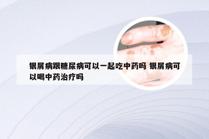 银屑病跟糖尿病可以一起吃中药吗 银屑病可以喝中药治疗吗
