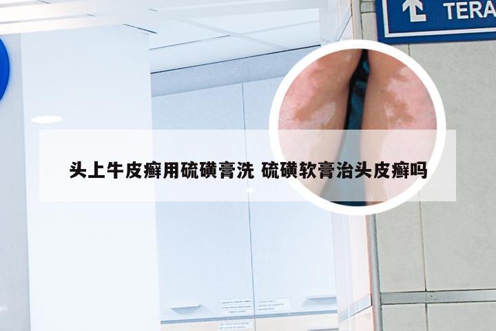 头上牛皮癣用硫磺膏洗 硫磺软膏治头皮癣吗