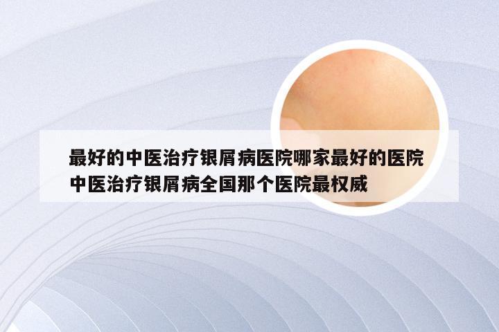 最好的中医治疗银屑病医院哪家最好的医院 中医治疗银屑病全国那个医院最权威