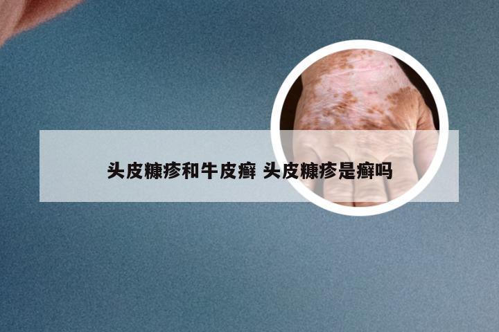 头皮糠疹和牛皮癣 头皮糠疹是癣吗