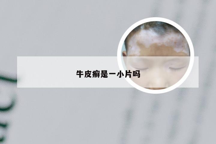 牛皮癣是一小片吗
