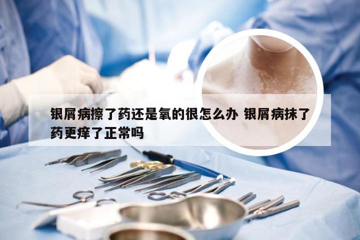 银屑病擦了药还是氧的很怎么办 银屑病抹了药更痒了正常吗