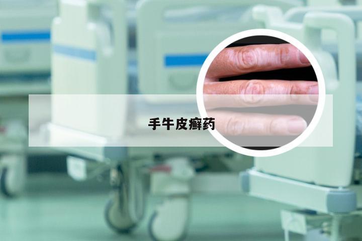 手牛皮癣药