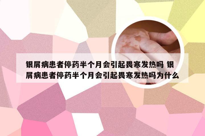 银屑病患者停药半个月会引起畏寒发热吗 银屑病患者停药半个月会引起畏寒发热吗为什么