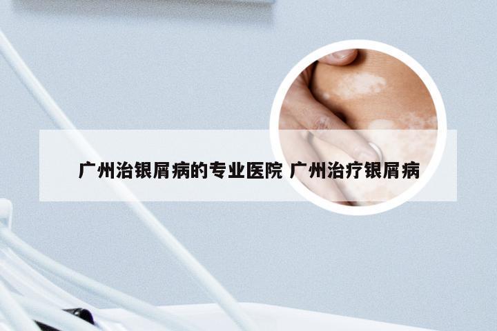 广州治银屑病的专业医院 广州治疗银屑病