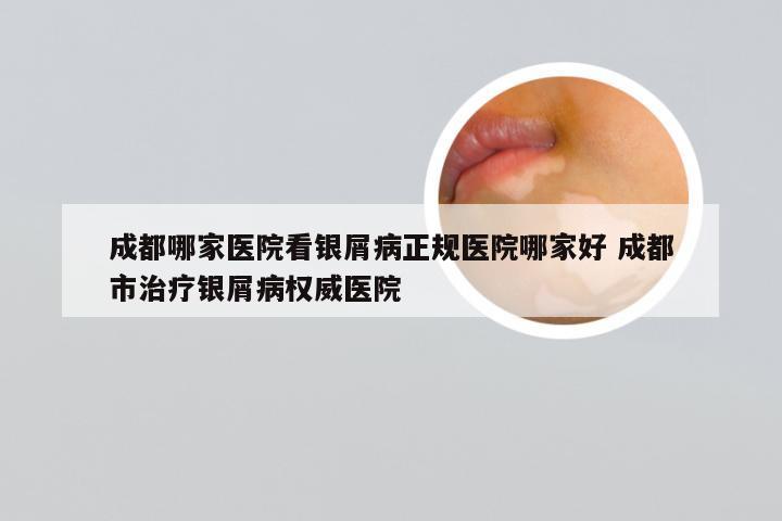 成都哪家医院看银屑病正规医院哪家好 成都市治疗银屑病权威医院