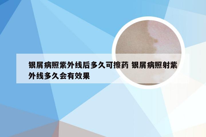 银屑病照紫外线后多久可擦药 银屑病照射紫外线多久会有效果