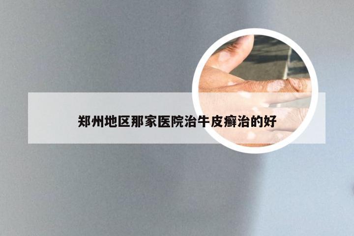 郑州地区那家医院治牛皮癣治的好