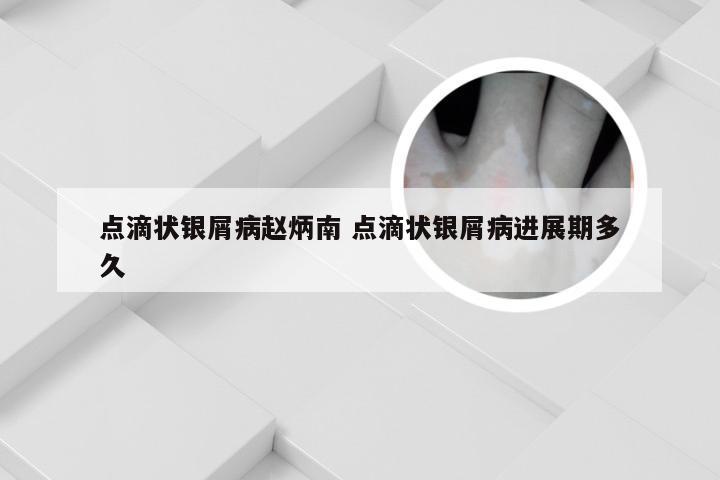 点滴状银屑病赵炳南 点滴状银屑病进展期多久
