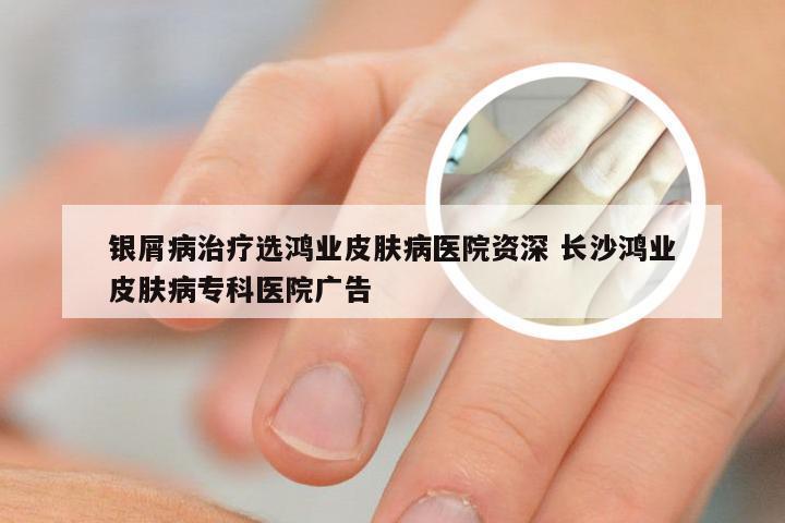银屑病治疗选鸿业皮肤病医院资深 长沙鸿业皮肤病专科医院广告