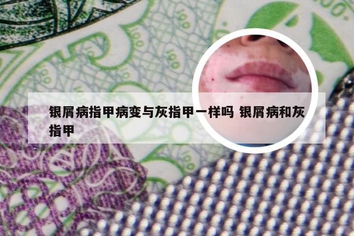 银屑病指甲病变与灰指甲一样吗 银屑病和灰指甲