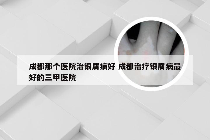 成都那个医院治银屑病好 成都治疗银屑病最好的三甲医院