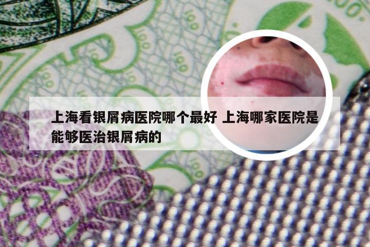 上海看银屑病医院哪个最好 上海哪家医院是能够医治银屑病的
