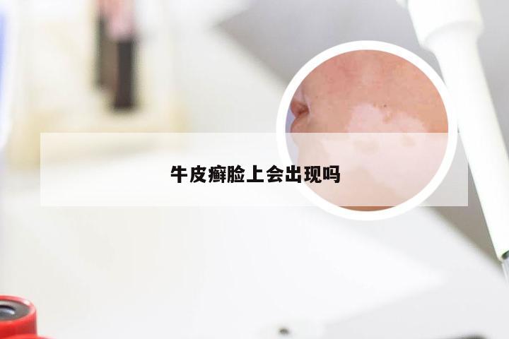 牛皮癣脸上会出现吗