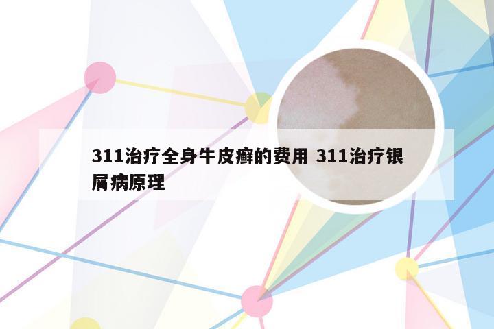 311治疗全身牛皮癣的费用 311治疗银屑病原理