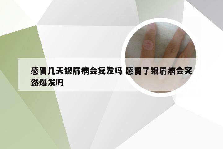 感冒几天银屑病会复发吗 感冒了银屑病会突然爆发吗