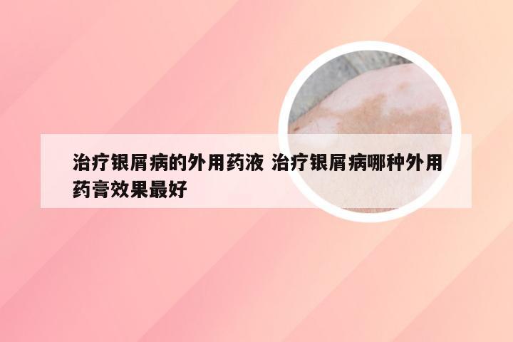 治疗银屑病的外用药液 治疗银屑病哪种外用药膏效果最好