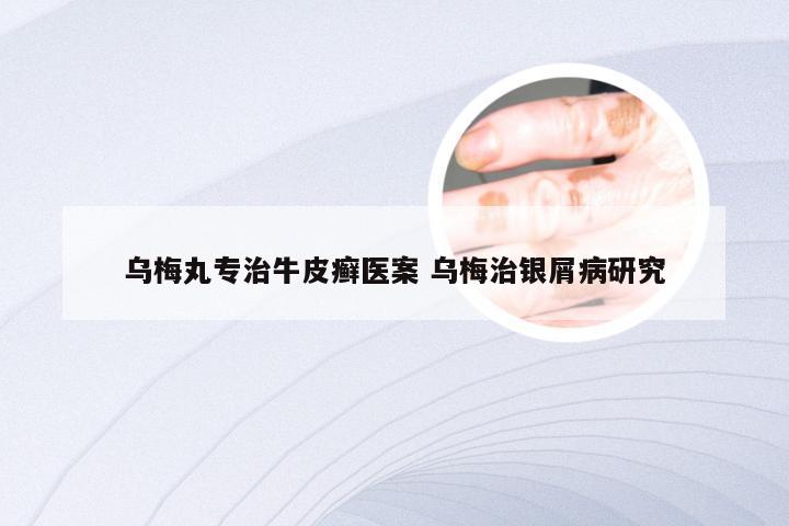 乌梅丸专治牛皮癣医案 乌梅治银屑病研究