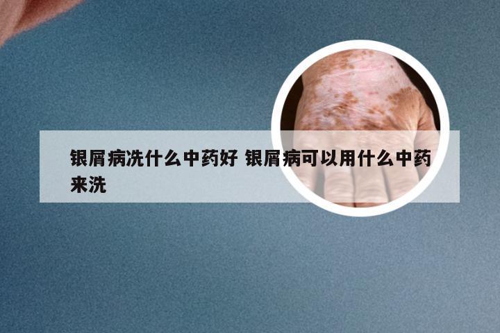 银屑病冼什么中药好 银屑病可以用什么中药来洗