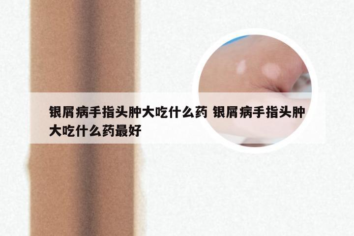 银屑病手指头肿大吃什么药 银屑病手指头肿大吃什么药最好