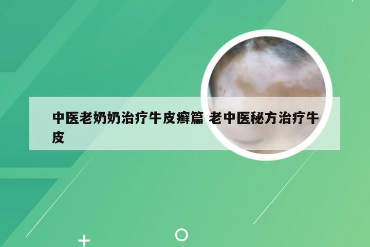 中医老奶奶治疗牛皮癣篇 老中医秘方治疗牛皮