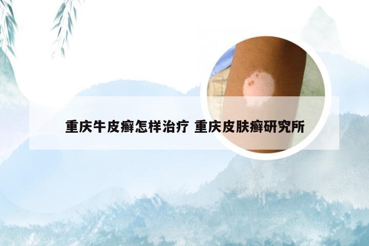 重庆牛皮癣怎样治疗 重庆皮肤癣研究所