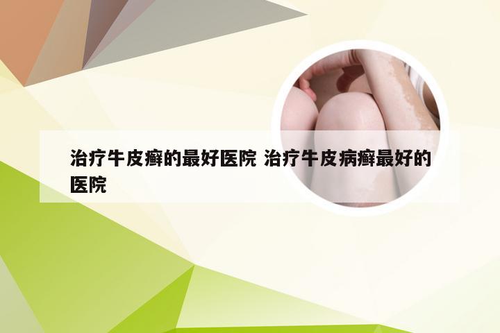 治疗牛皮癣的最好医院 治疗牛皮病癣最好的医院