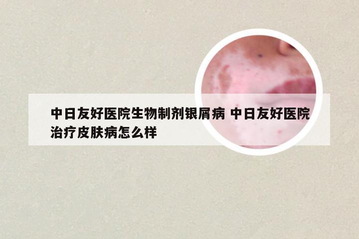 中日友好医院生物制剂银屑病 中日友好医院治疗皮肤病怎么样