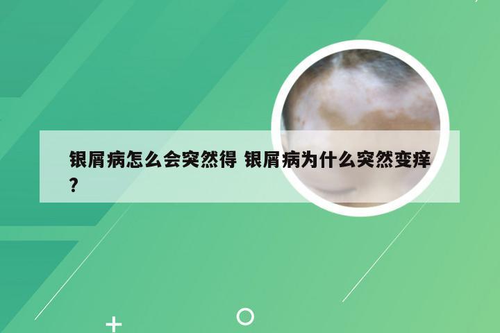 银屑病怎么会突然得 银屑病为什么突然变痒?